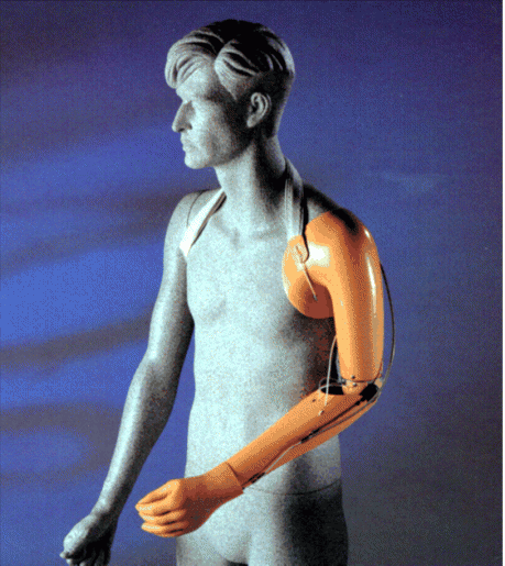 Versorgung bei Oberarmamputation