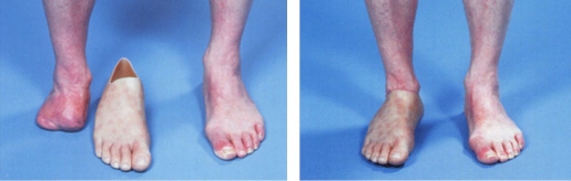 Versorgung bei Vorfußamputation