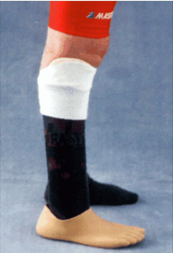 Versorgung bei Rückfußamputation