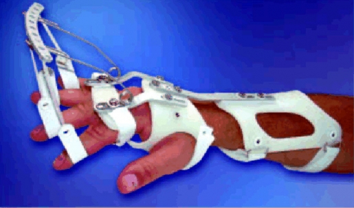 Dynamische Handgelenksorthese DAHO Typ 2.1