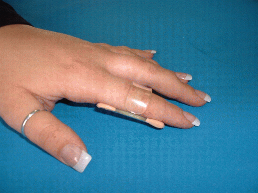 Strecksehnenschiene kurz nach Maß