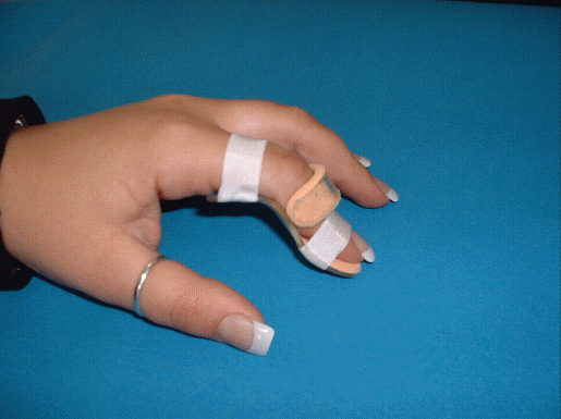 Strecksehnenschiene nach Maß